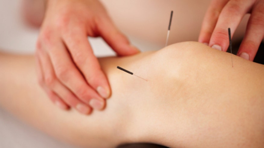 needle acupuncture